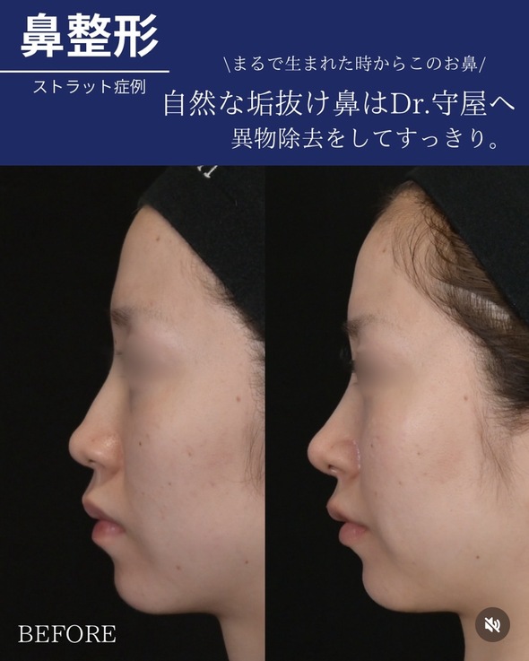 守屋医師による鼻整形の術前/術後3ヶ月