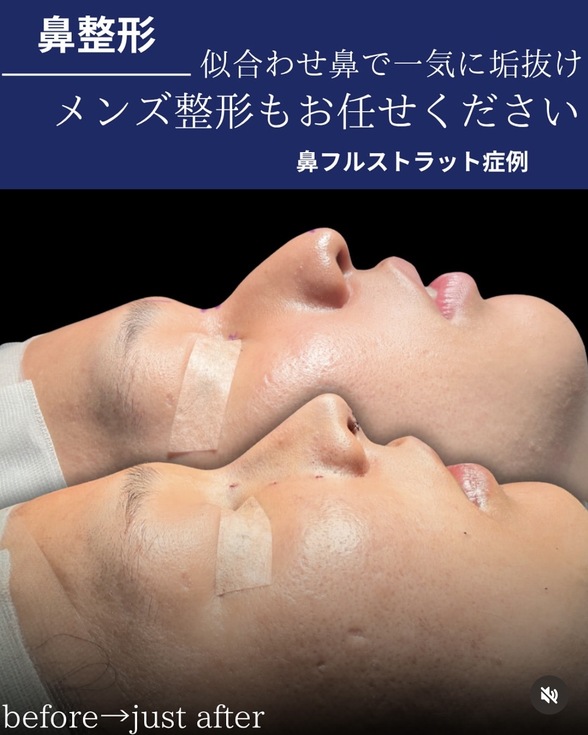 守屋医師による鼻整形の術前/直後