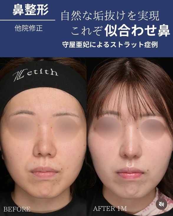 守屋医師による鼻整形の術前/術後1ヶ月