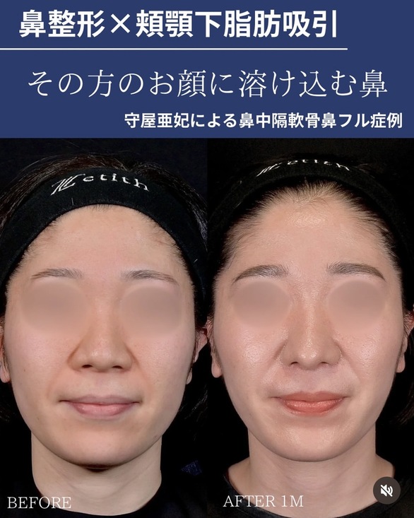 守屋医師による鼻整形の術前/術後1ヶ月