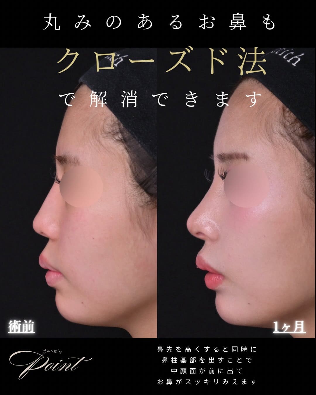 羽根医師による鼻整形の術前/術後1ヶ月 术后 