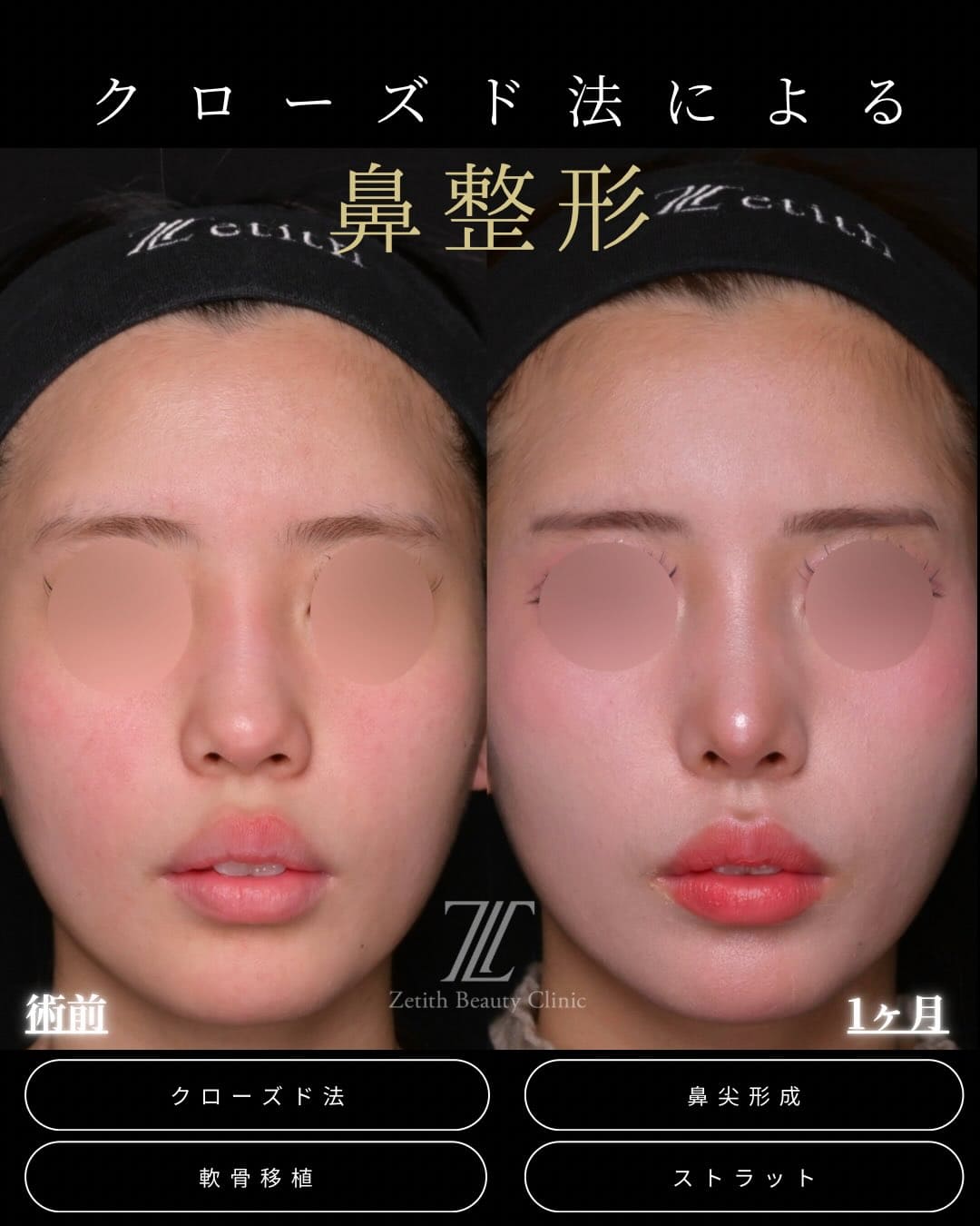 羽根医師による鼻整形の術前/術後1ヶ月