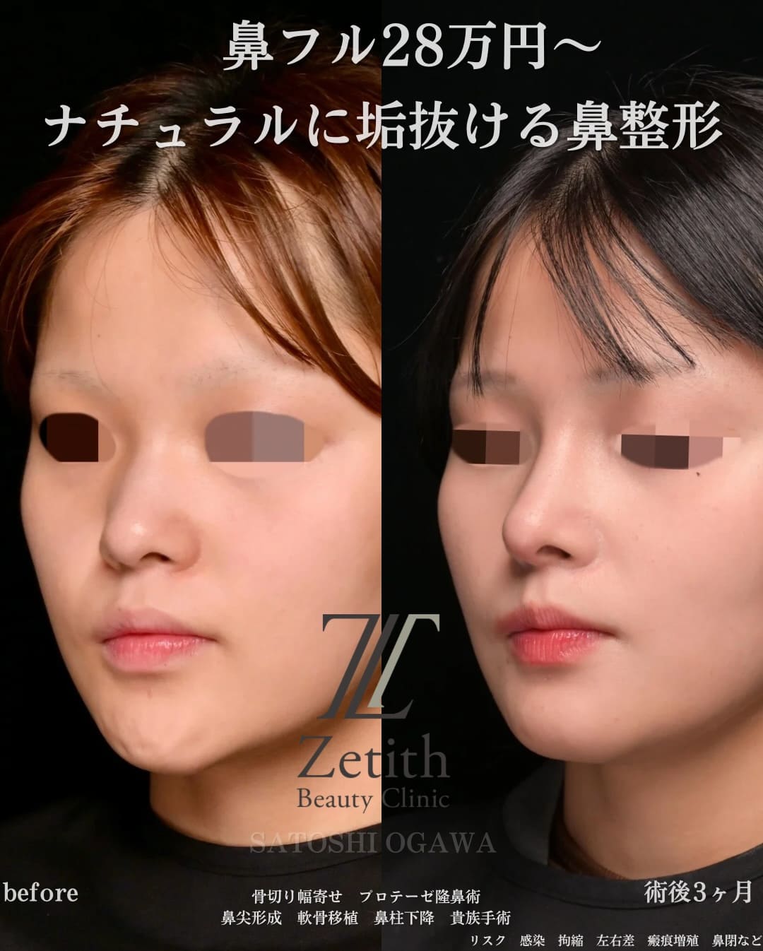 小川医師による鼻整形の術前/術後３ヶ月 施術後 
