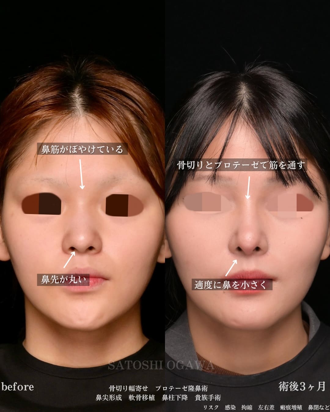 小川医師による鼻整形の術前/術後３ヶ月