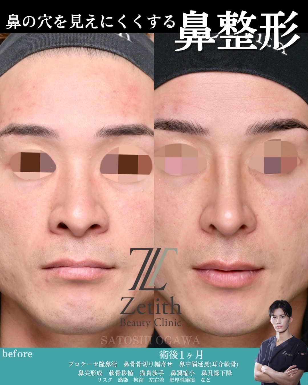鉄医師による鼻整形の術前/術後1ヶ月