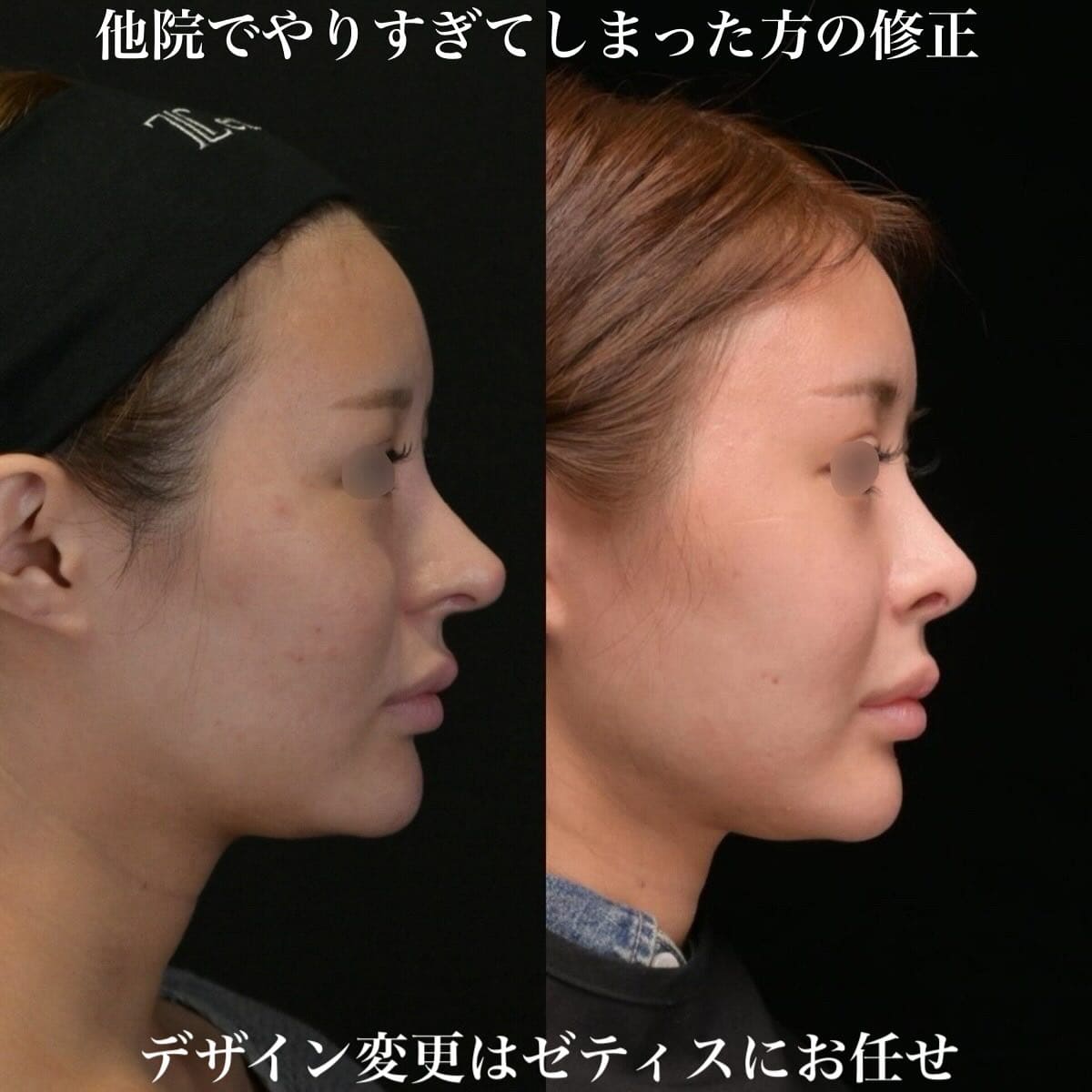 鉄医師による鼻整形の術前/術後1年
