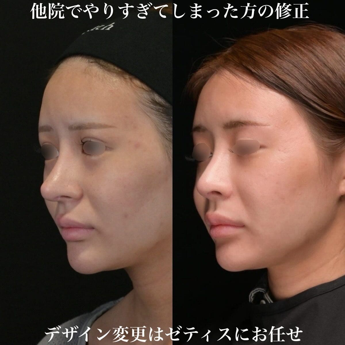 鉄医師による鼻整形の術前/術後1年 Дараа 