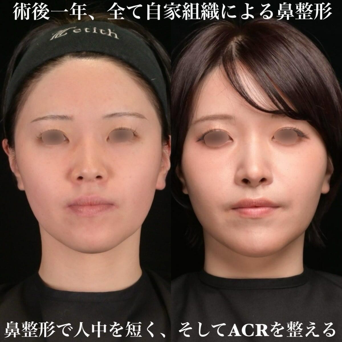 鉄医師による鼻整形の術前/術後1年