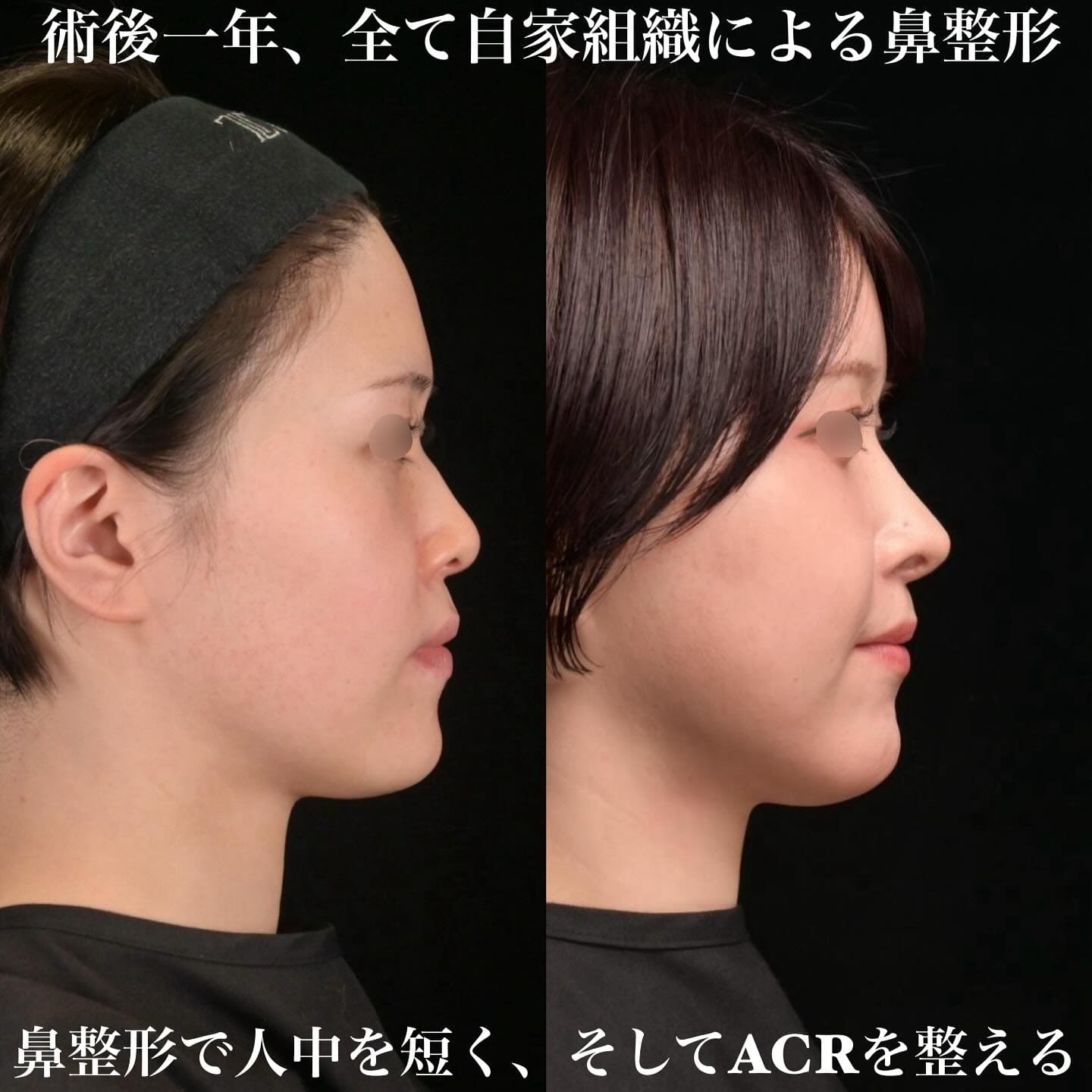 鉄医師による鼻整形の術前/術後1年 术后 