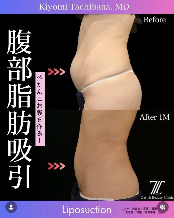 橘医師による脂肪吸引の術前/術後1ヶ月 施術前