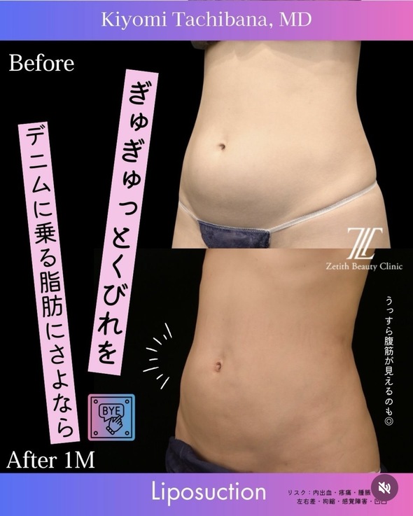橘医師による脂肪吸引の術前/術後1ヶ月 施術後 1ヶ月