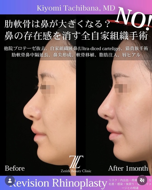 橘医師による鼻整形の術前/術後1ヶ月 施術前