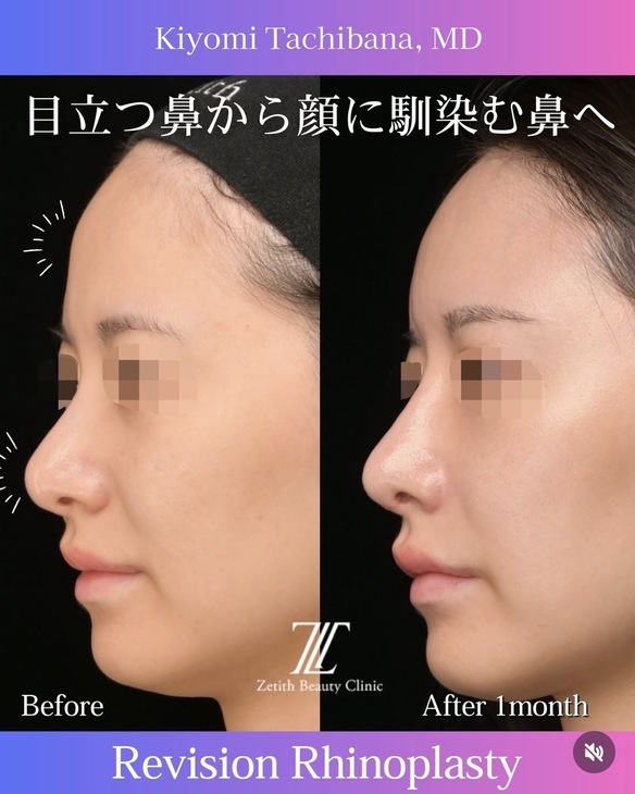 橘医師による鼻整形の術前/術後1ヶ月 施術後 1ヶ月
