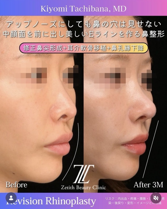 橘医師による鼻整形の術前/術後3ヶ月 施術後 3ヶ月