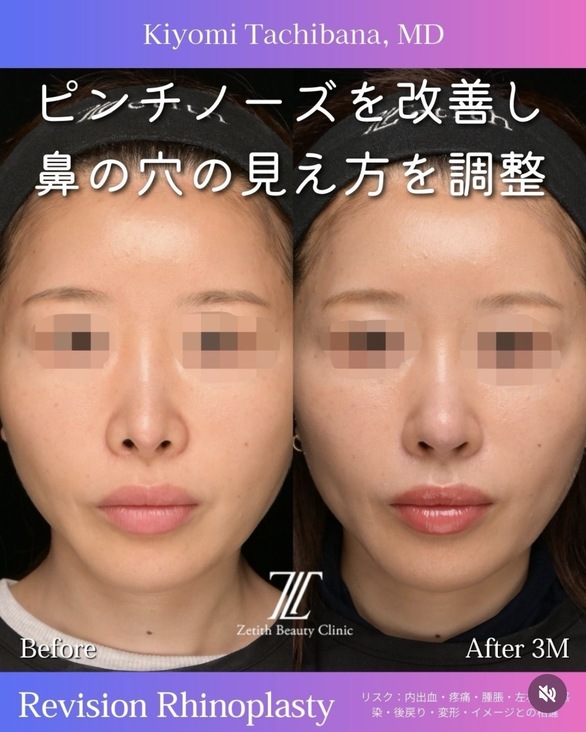 橘医師による鼻整形の術前/術後3ヶ月 施術前