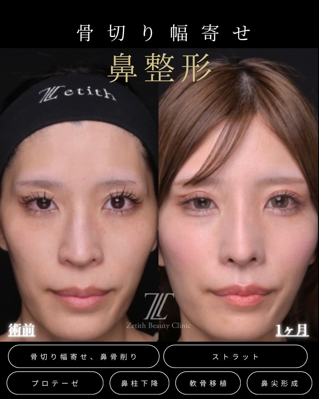 羽根医師による鼻整形の術前/術後1ヶ月｜ゼティスビューティークリニック