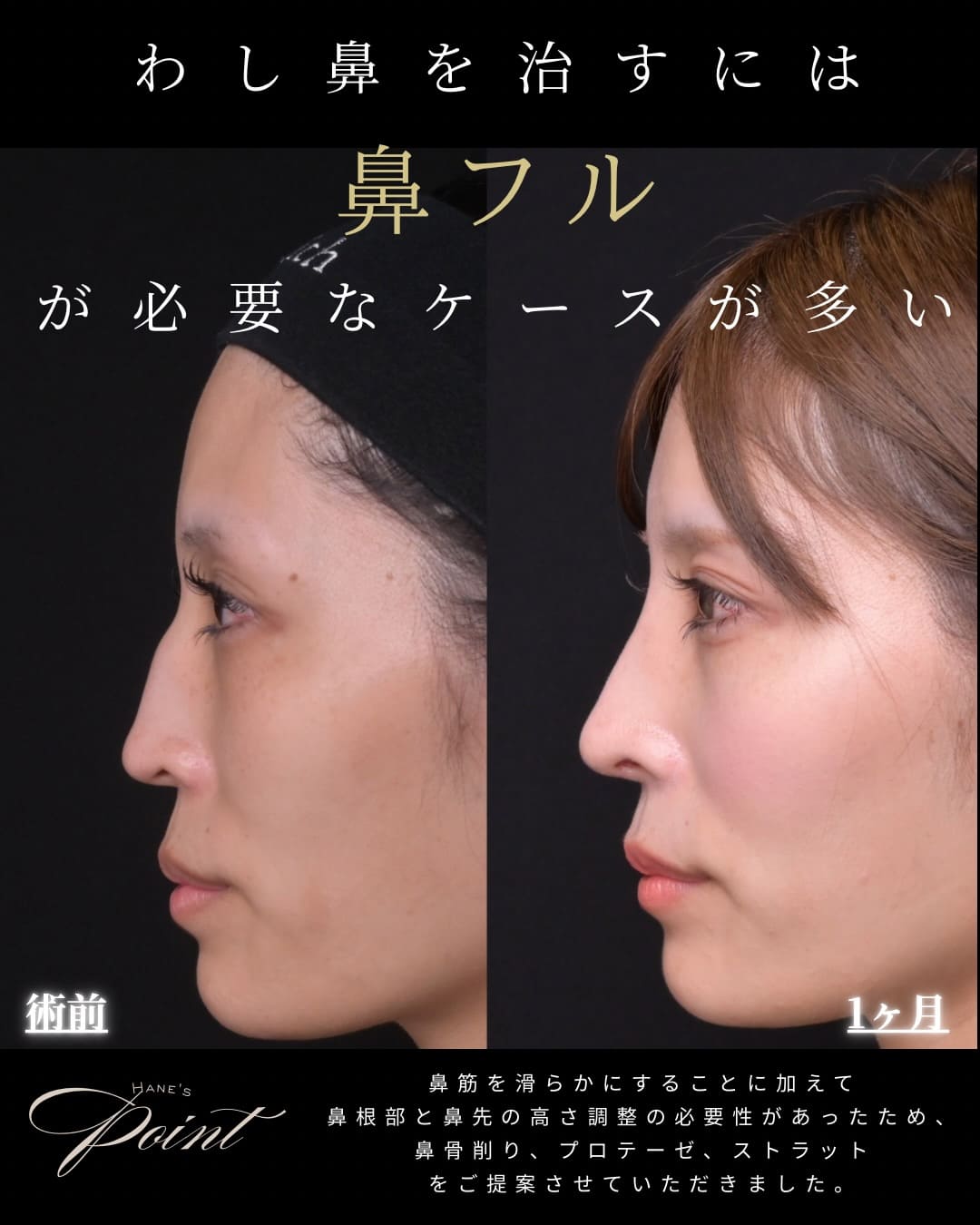 鼻形成術 Rebuilding Nose 鼻整形 鼻形成術 Rebuilding Nose | 鄭載用(ジョン・ジェヨン), Jaeyong Jeong