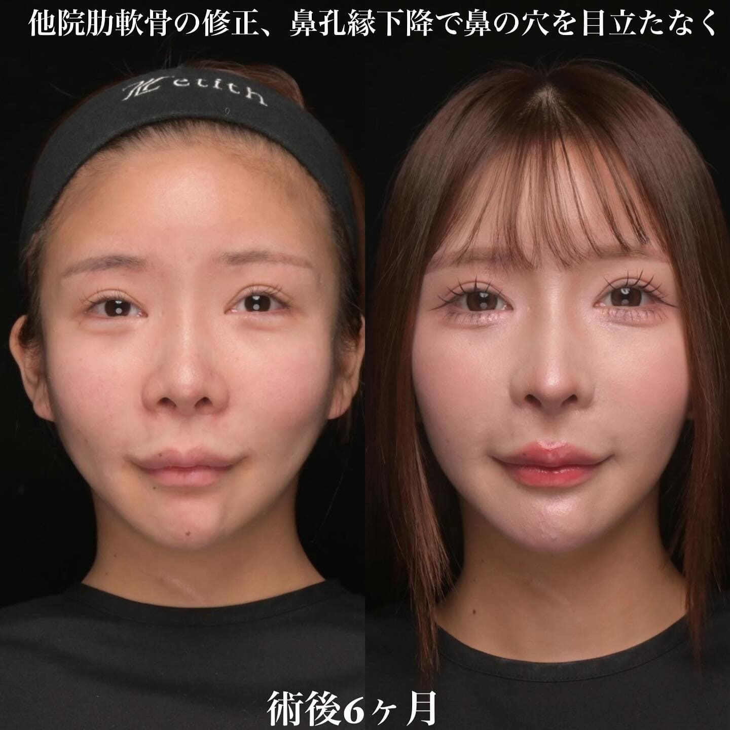 症例写真1