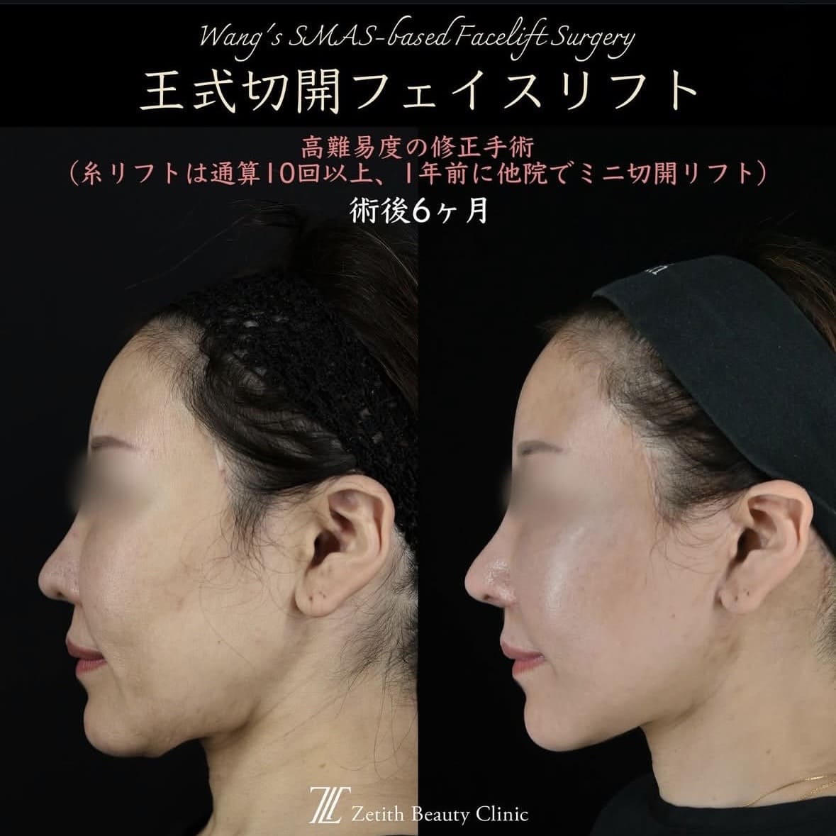 王医師による切開リフトの術前/術後6ヶ月 施術後 6ヶ月