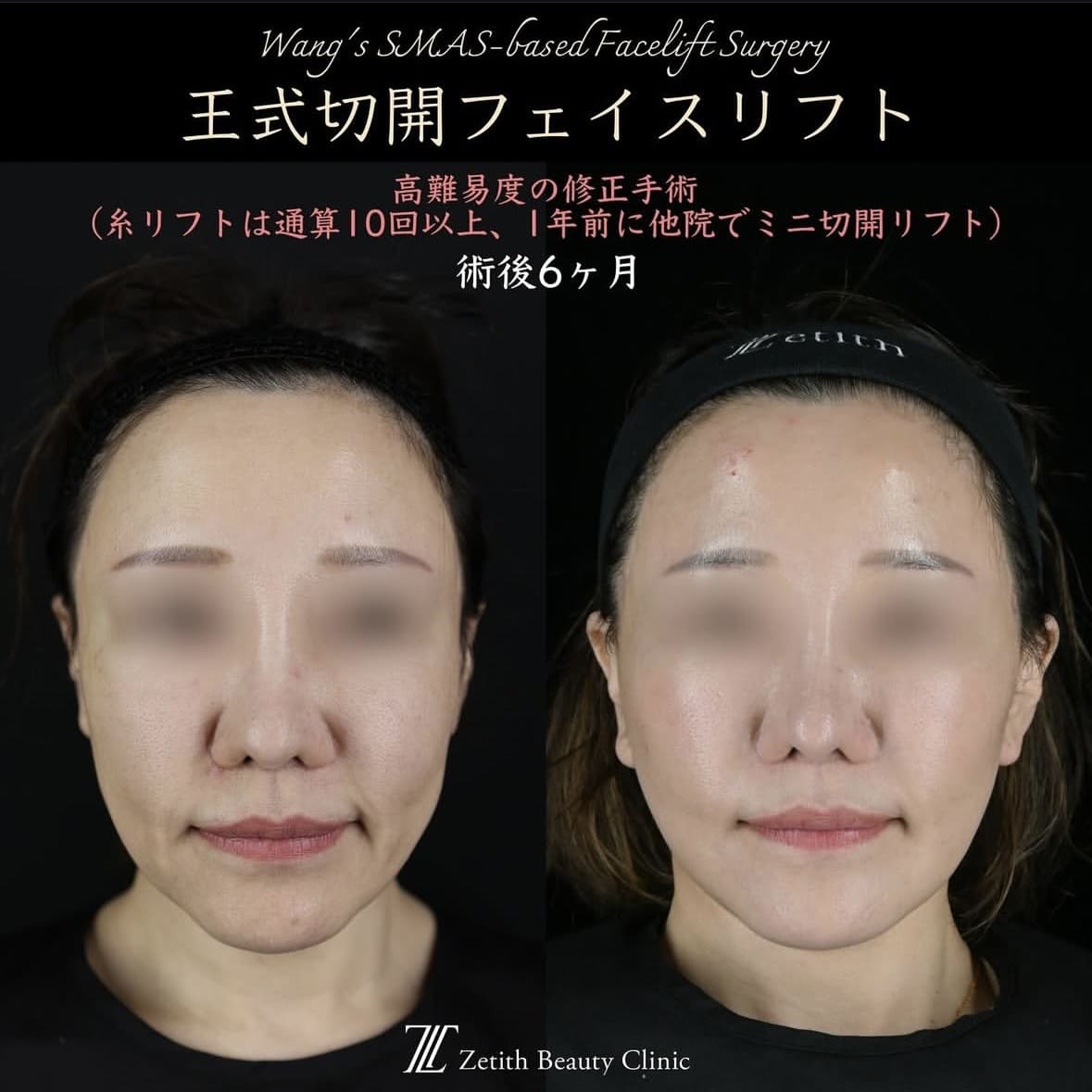 王医師による切開リフトの術前/術後6ヶ月 施術前