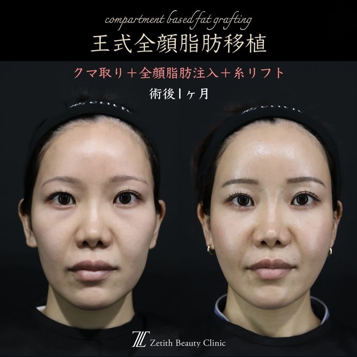 王医師による複合施術の術前/術後1ヶ月後 施術前