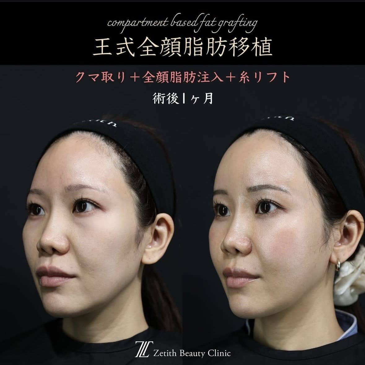 王医師による複合施術の術前/術後1ヶ月後 施術後 1ヶ月