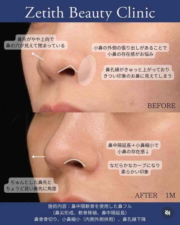 守屋医師による鼻整形の術前/術後1ヶ月 术后 