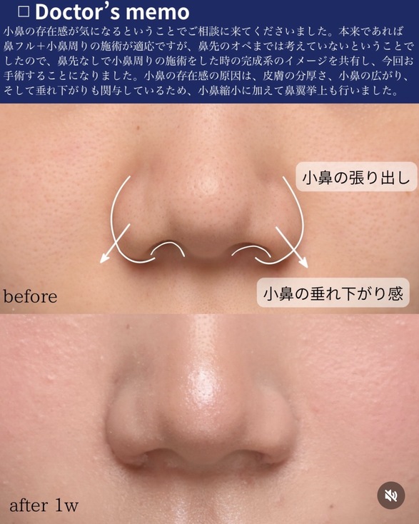 守屋医師による小鼻縮小の術前/術後1ヶ月 بعد 