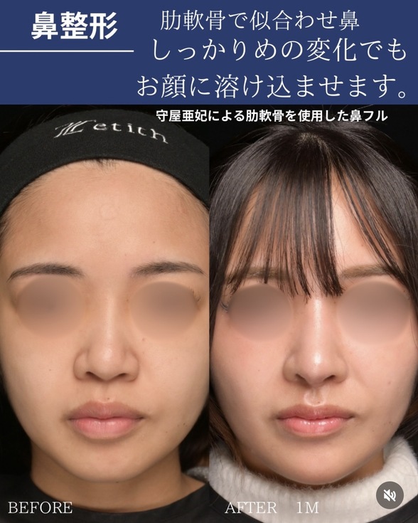 鼻整形