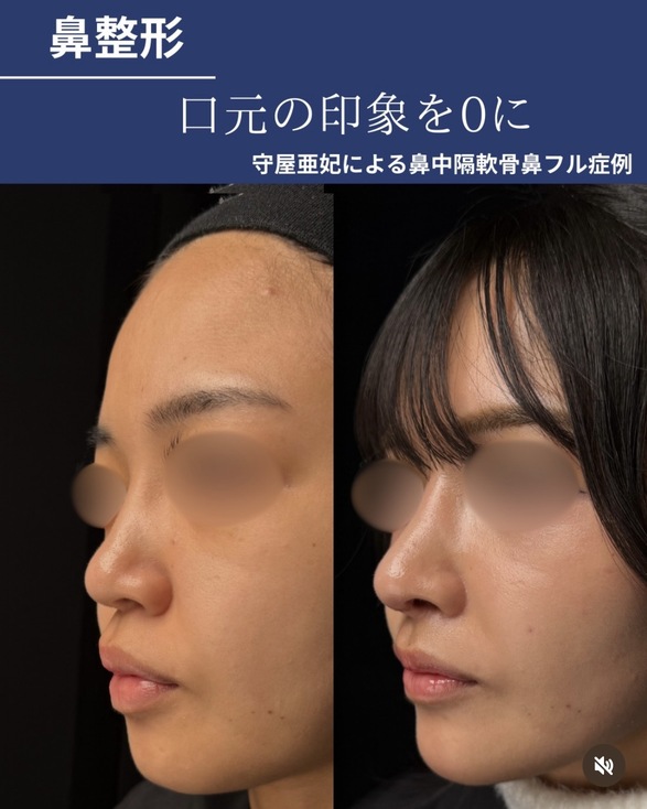 守屋医師による鼻整形の術前/術後1ヶ月 施術後 