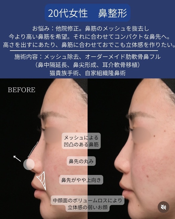 守屋医師による鼻整形の術前/術後1ヶ月 施術後 