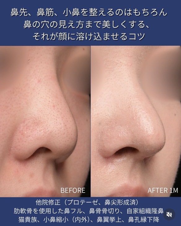 守屋医師による鼻整形の術前/術後1ヶ月 施術後 