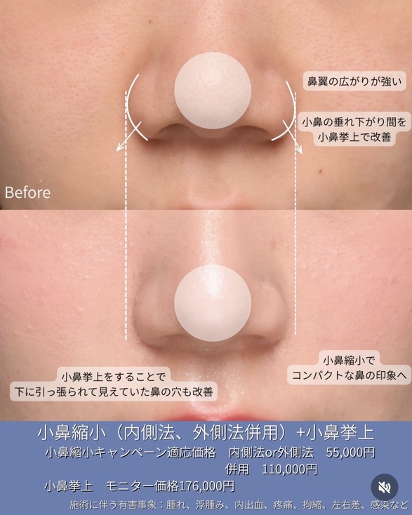 守屋医師による鼻整形の術前/術後3ヶ月 施術後 