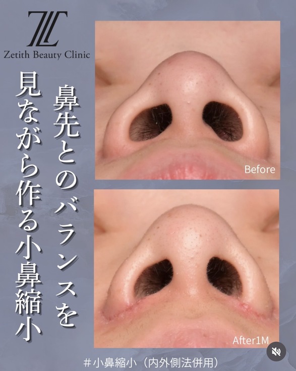小鼻縮小