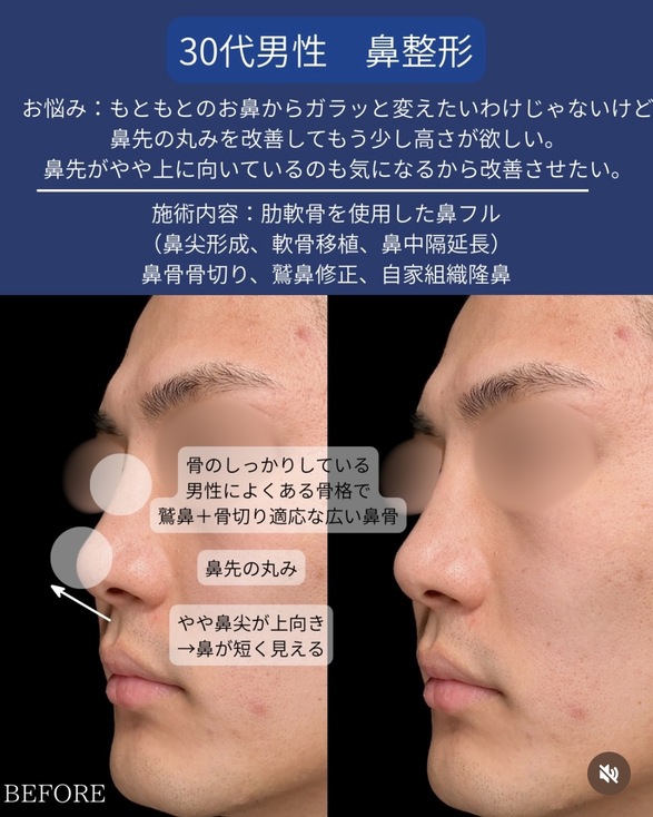 守屋医師による鼻整形の術前/術後1ヶ月 施術後 