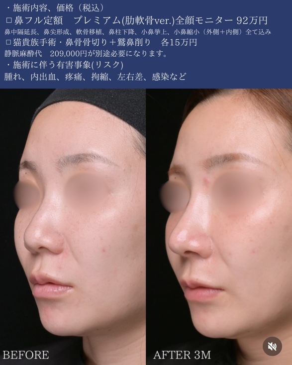 守屋医師による鼻整形の術前/術後3ヶ月 术后 
