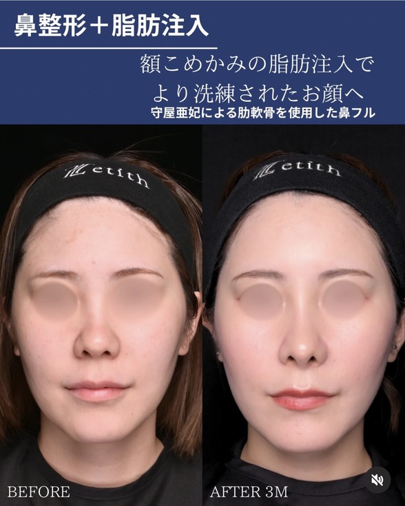 守屋医師による鼻整形の術前/術後3ヶ月 Дараа 