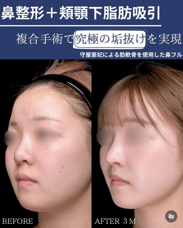複合手術
