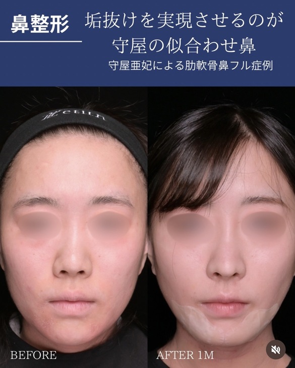 鼻整形