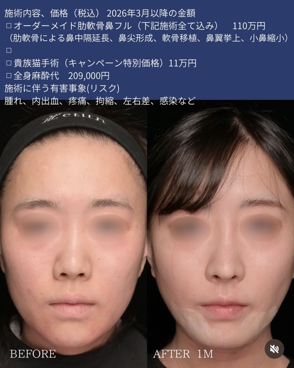 守屋医師による鼻整形の術前/術後1ヶ月 施術後 