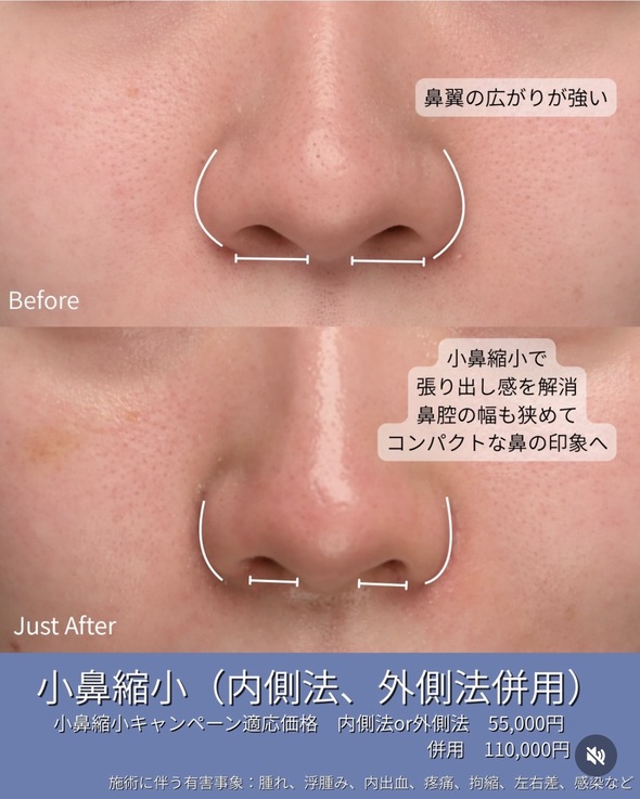 守屋医師による小鼻縮小の術前/術後1週間 Дараа 