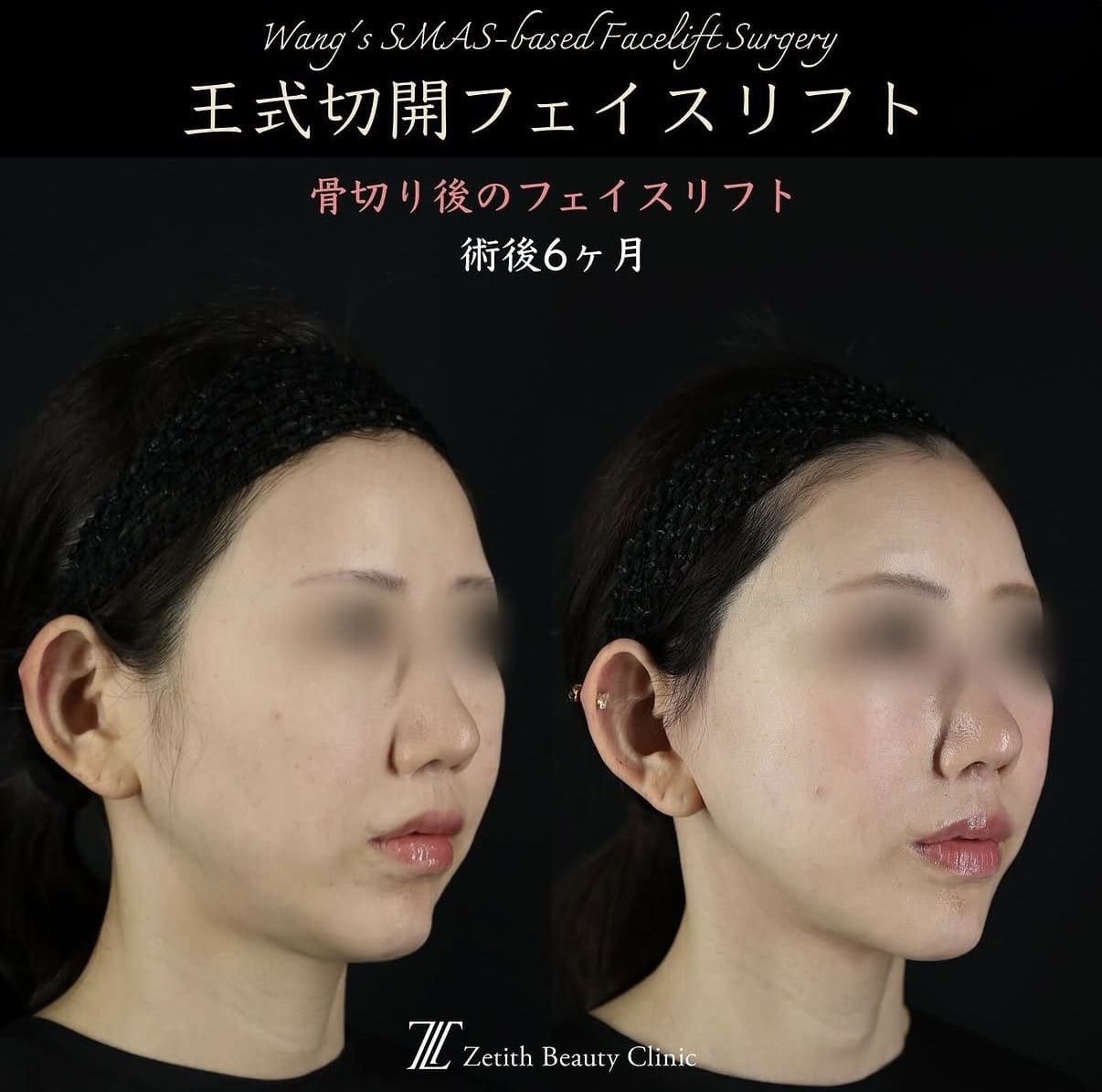 切開リフト
