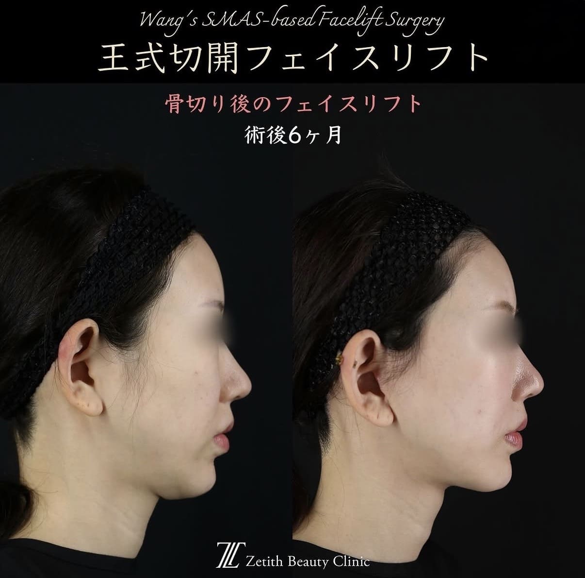 王医師による切開リフトの術前/術後6ヶ月 Дараа 