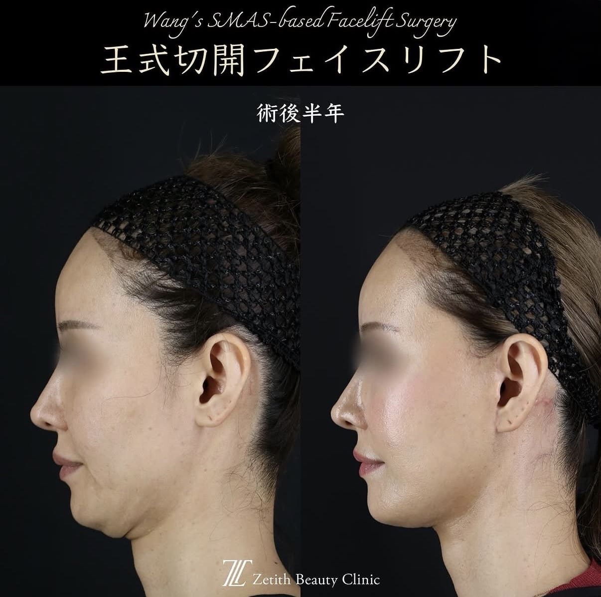 王医師による切開リフトの術前/術後6ヶ月 بعد 