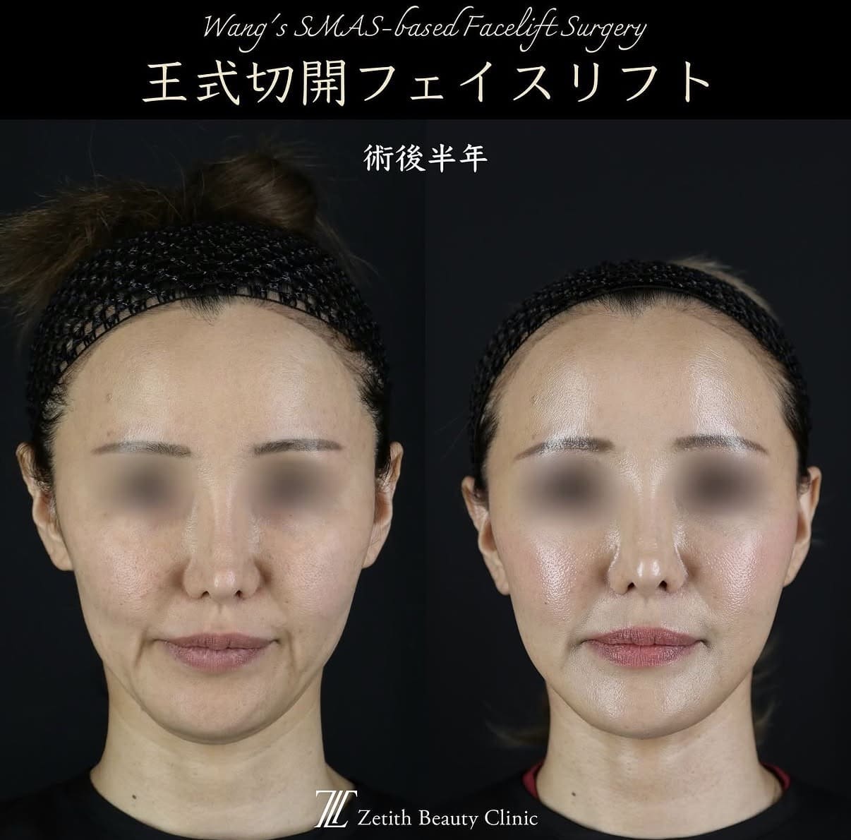 切開リフト