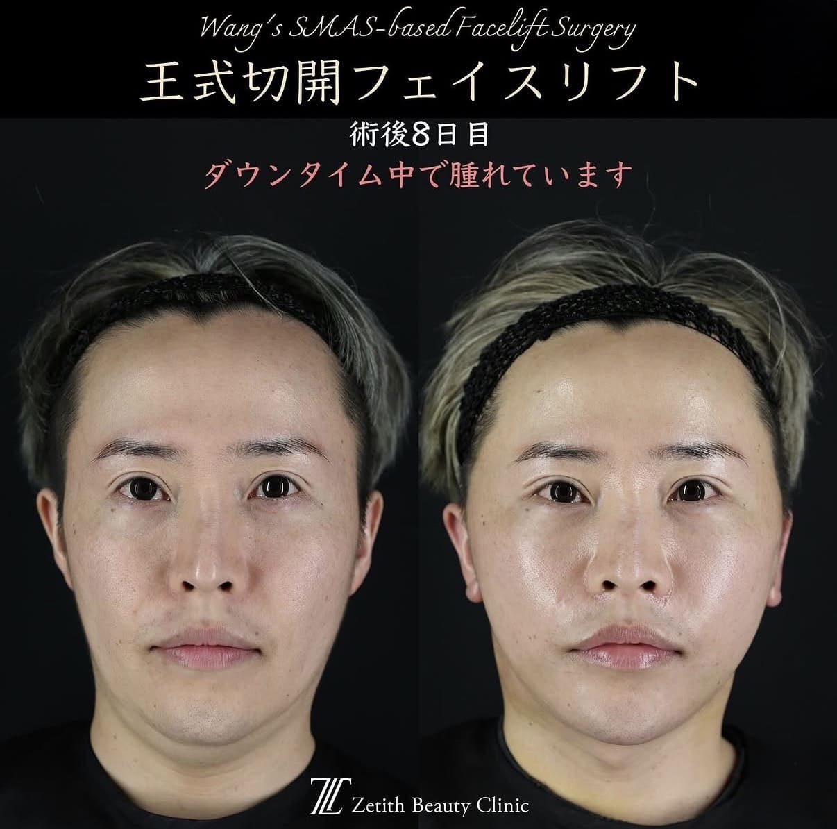 切開リフト