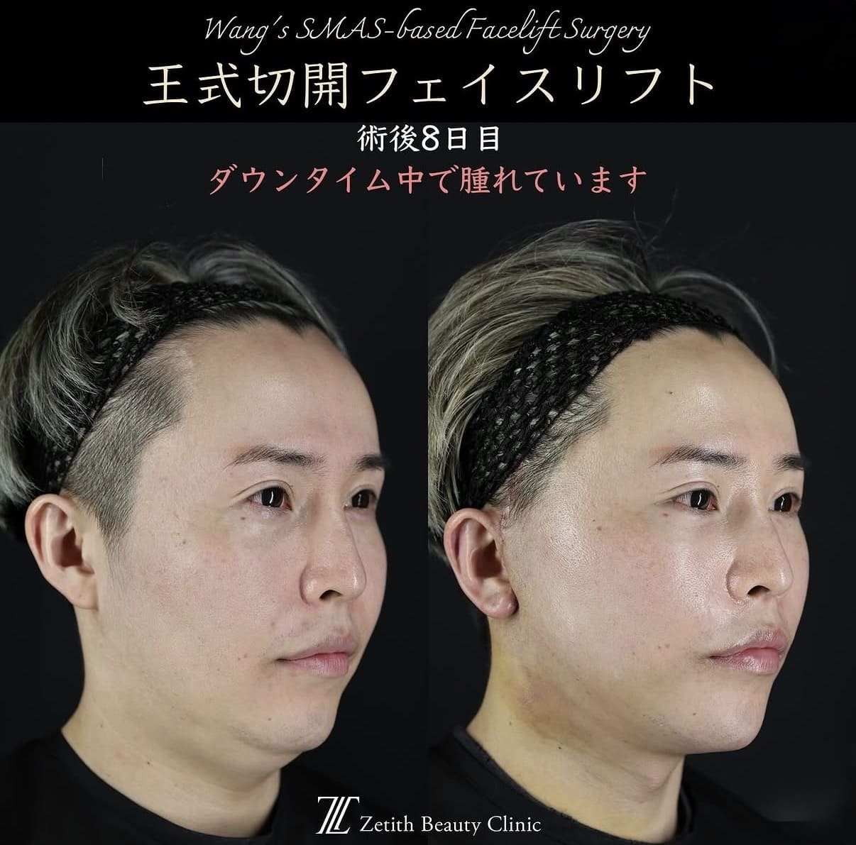 王医師による切開リフトの術前/術後8日目 术后 