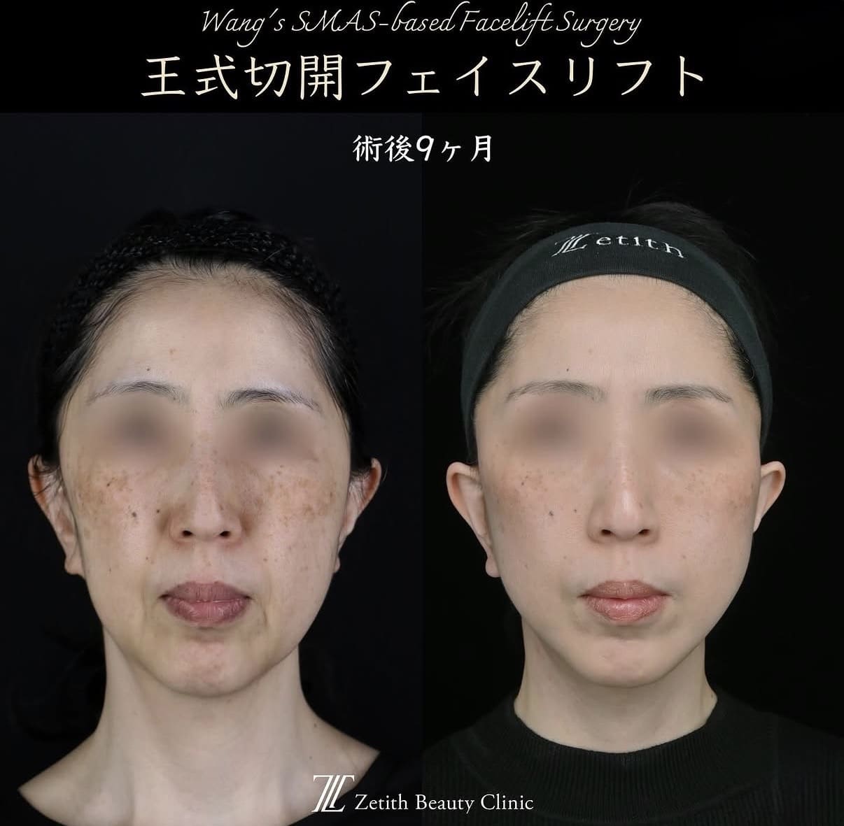 王医師による切開リフトの術前/術後9ヶ月 施術後 