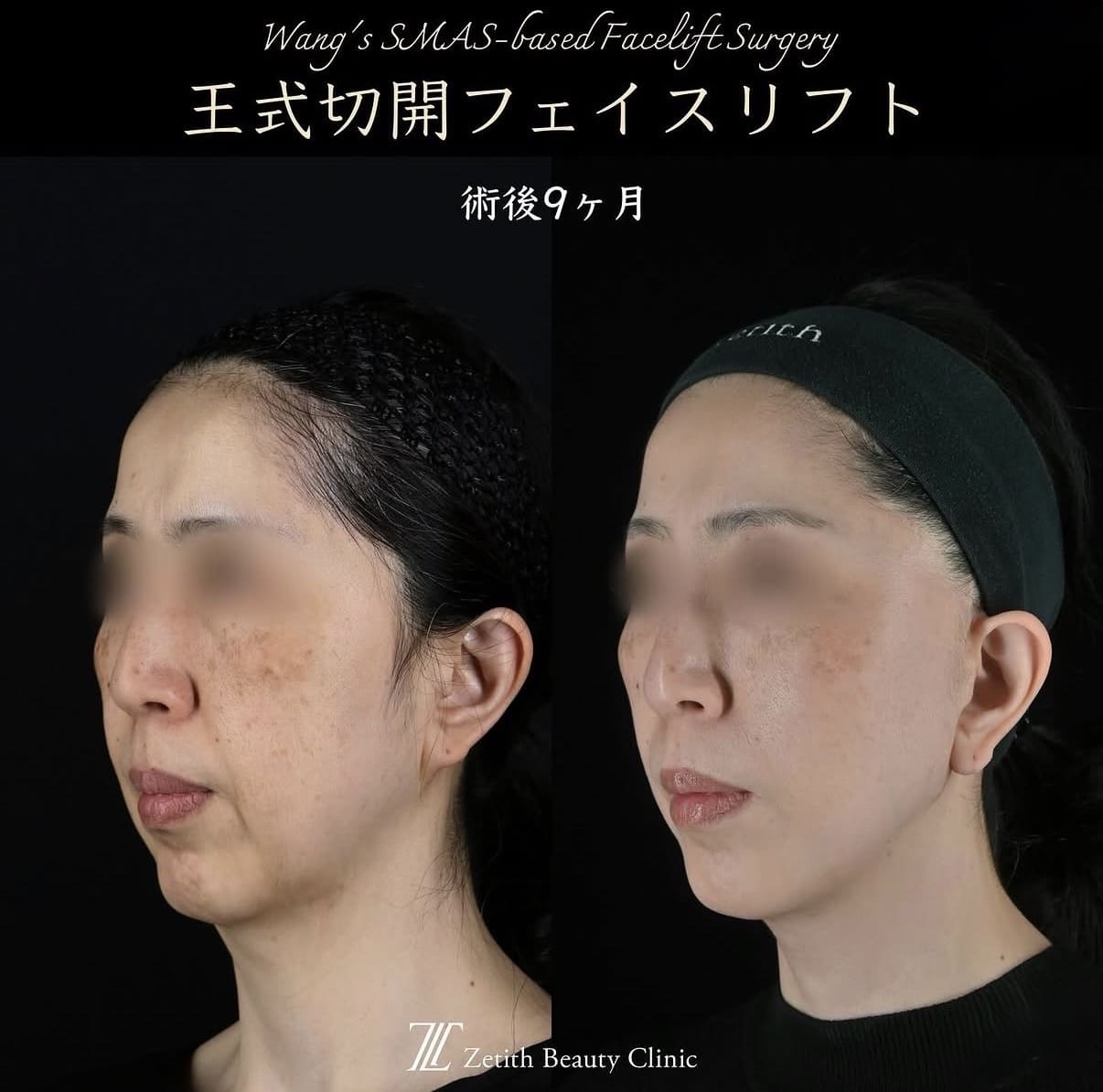 切開リフト