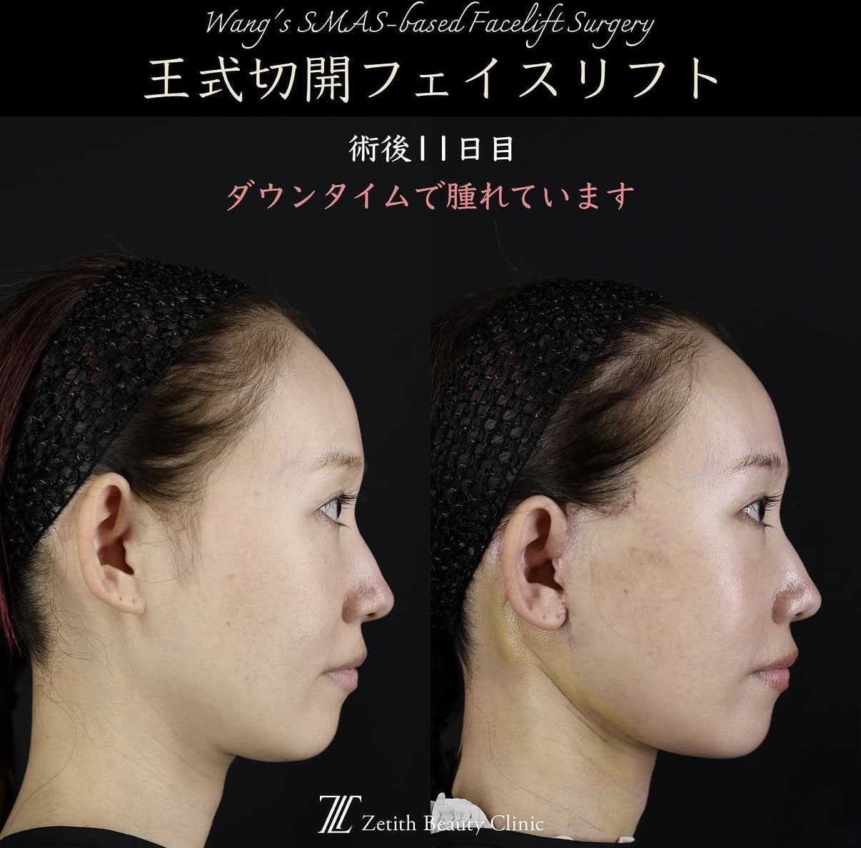 切開リフト